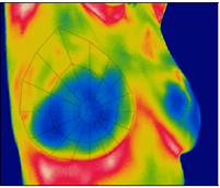 Breast Thermography
