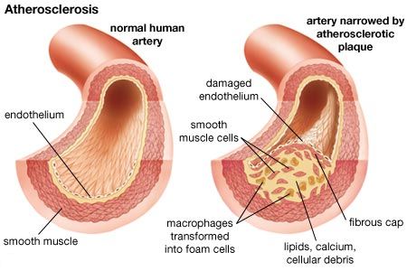 Arteries - Cardiovascular-Disease